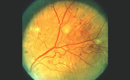 Retinopatía diabética en Metepec