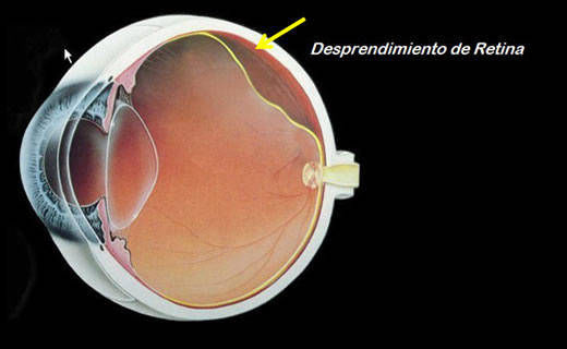 Desprendimiento de Retina en San Mateo Atenco