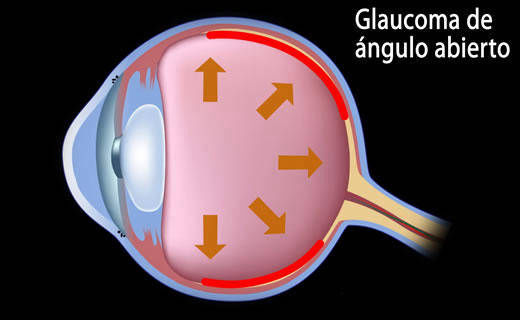 Cirugía de Glaucoma en Metepec