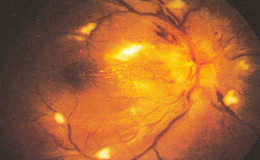 Cirugía de Retinopatía Hipertensiva en San Mateo Atenco